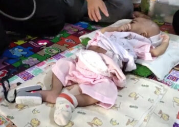 Kasihan, Bayi Bilqis Lahir Tanpa Memiliki Saluran Pembuangan